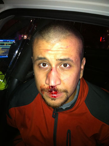 Police photo of George Zimmerman taken the night he shot and killed Trayvon Martin.
