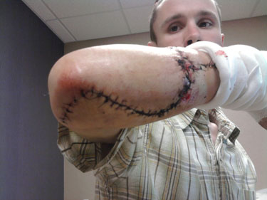 Adam Thull was building a checkout counter for a local bookstore when he noticed a wood panel falling off the edge of his table. As he lunged to catch it, his right forearm got caught on the blade of his Ryobi table saw – and the machine quickly cut completely through one of his forearm bones and a nerve.